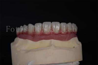 Natural Aesthetics with Affordable All on 4 All on 6 Implants