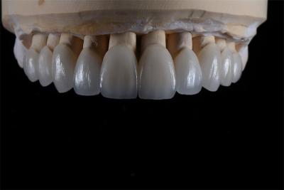 Veneers Stain Resistant Comfortable Fit